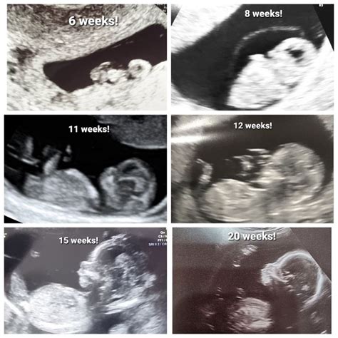 Week By Week Ultrasounds | Ultrasound pictures, Baby ultrasound, 20 weeks