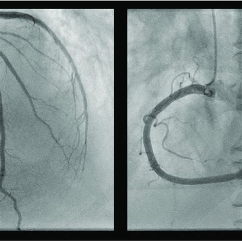 Coronary Angiography at Admission. The results of the coronary ...