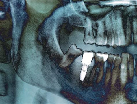 What do we need to know about dental radiography? - Doctor Kurbe