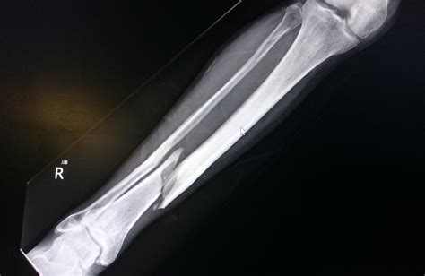 Tibia fracture: Types, symptoms, and treatment