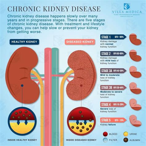 How Many Stages Of Kidney Failure - HealthyKidneyClub.com