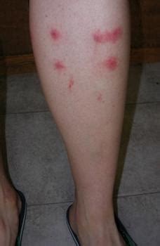 Do Gnats bite? Symptoms, Treatments and Pictures