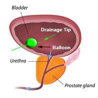 Indwelling Foley Catheters Becoming A Thing Of The Past?