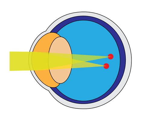 astigmatism の意味・例文・発音・語源・イメージ画像 - KOTOBA