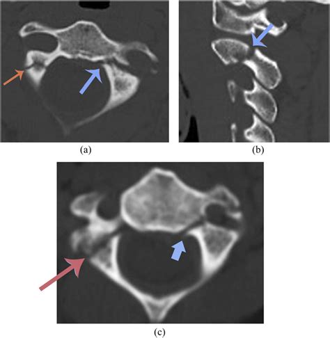 Two young males with hangman's fracture: (a) axial and (b) sagittal ...