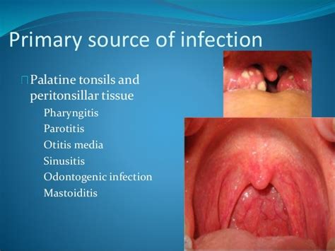 Lemierre syndrome