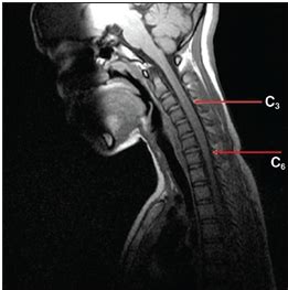 Neuromyelitis Optica Causes, Symptoms, Diagnosis and Treatment - Natural Health News