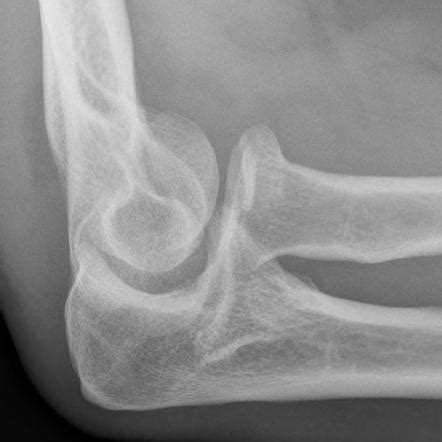 Radial head fracture | Radiology Reference Article | Radiopaedia.org