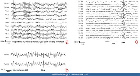 Epilepsy with myoclonic-atonic seizures | MedLink Neurology