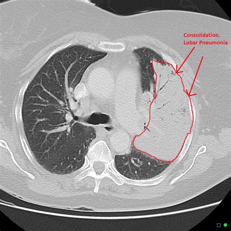 Pneumonia CT - wikidoc