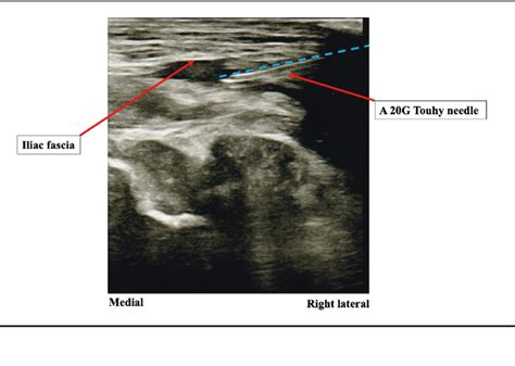 Representative ultrasound image of right fascia iliaca block. The... | Download Scientific Diagram