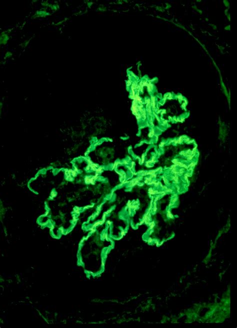 Glomerular Basement Membrane Histology