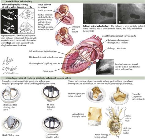 Acute Rheumatic Fever and Rheumatic Heart Disease | Clinical Gate