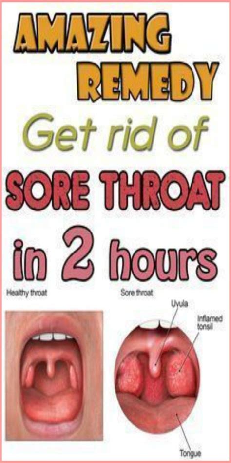 Amazing Remedy Get Rid Of Sore Throat In 2 Hours | Throat remedies, Strep throat remedies, Sore ...