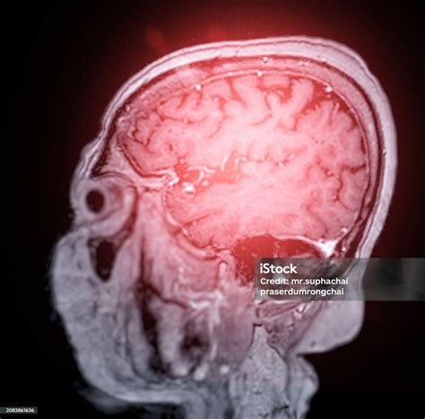 Mri Brain Scan Sagittal Plane For Detect Brain Diseases Sush As Stroke Disease Brain Tumors And ...