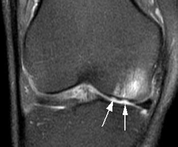 Cartilage Defect of Lateral Femoral Condyle | Radsource