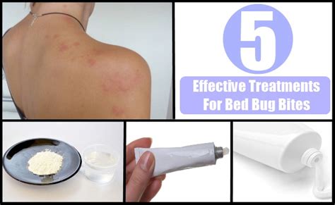 5 Effective Treatments For Bed Bug Bites – Natural Home Remedies ...