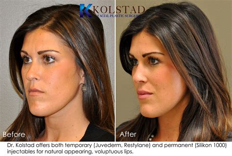 Lip Augmentation Before & After Gallery | Dr. Kolstad - San Diego Facial Plastic Surgeon