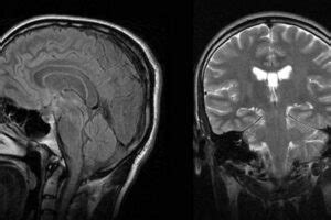 DIFFERENCE BETWEEN NARCOLEPSY BRAIN AND NORMAL BRAIN