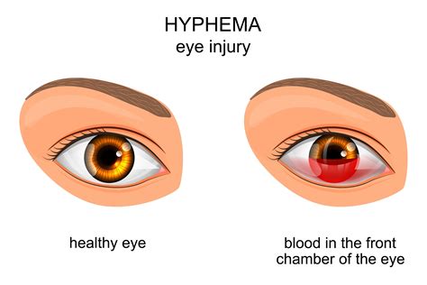 Understanding Hyphema: Symptoms, Treatment & More | NVISION Eye Centers