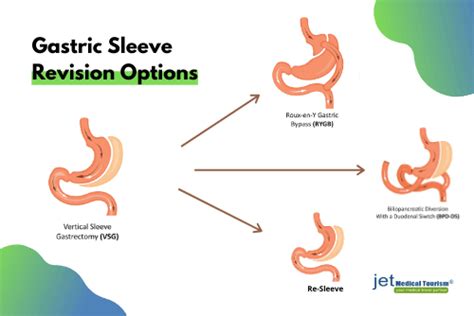 Gastric Sleeve Revision: An Ultimate Guide to VSG Revision