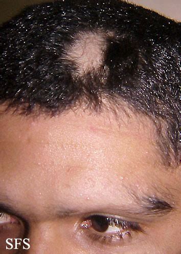 Alopecia areata - wikidoc