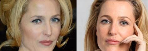 Gillian Anderson Plastic Surgery | Plastic Surgery Magazine