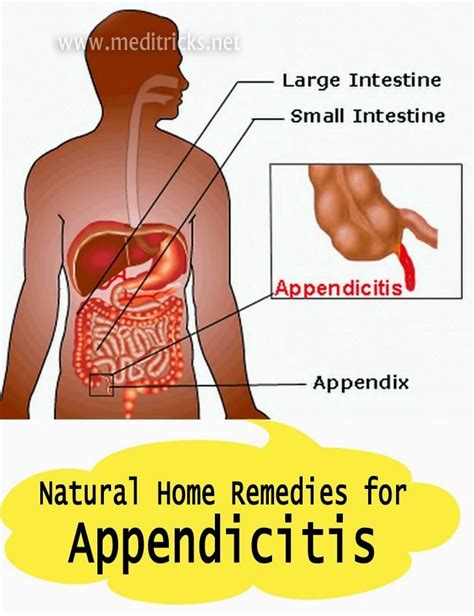 Natural Home Remedies for Appendicitis | Natural home remedies, Home remedies, Natural healing ...