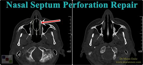 Health Zone Turkey: Cost of Nasal Septum Perforation Repair in İstanbul