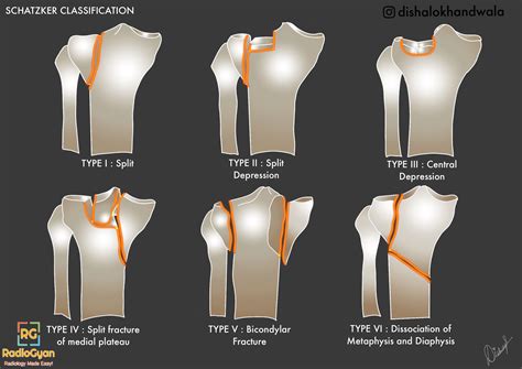 Schatzker Classification of Tibial Plateau Fractures | Tibial plateau ...