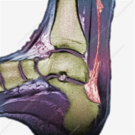 MRI of a rupture of the Achilles Tendon - Stock Image - C005/5425 - Science Photo Library