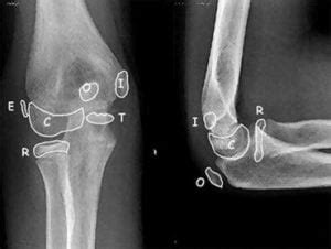 Tiny Tip: Is this a ‘CASE’ of an elbow fracture? - CanadiEM