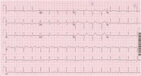 How to assess acute coronary syndrome | 12- lead EKG case