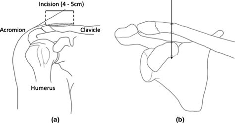 Schematic of the surgery. a A skin incision is made above the coracoid.... | Download Scientific ...