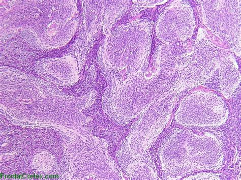 Medulloblastoma With Extensive Nodularity, H&E stain x 100