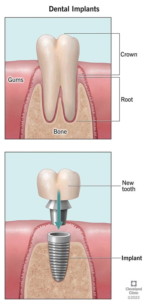 Dental Implants: Procedure, Purpose & Benefits