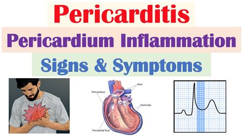 Pericarditis (Pericardial Inflammation) Signs & Symptoms (& Why They ...