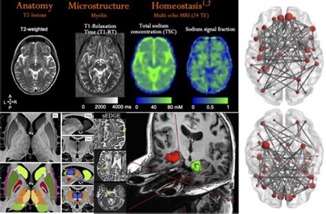 Brain Imaging - Center for Magnetic Resonance in Biology and Medicine