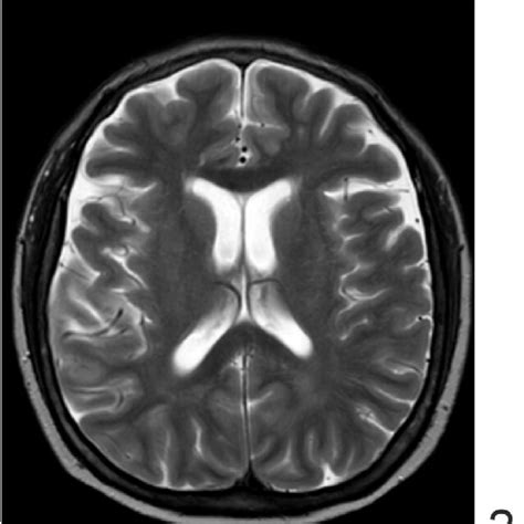 MRI brain with contrast: Figs. 1-3: Extensive abnormal T2 hyperintense... | Download Scientific ...