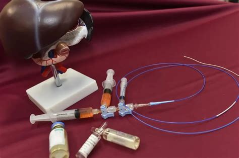 Chemoembolization of the liver: indications, preparation for the procedure, algorithm of ...