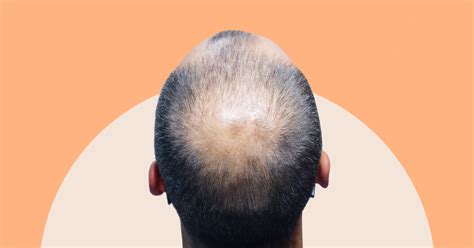 Androgenic Alopecia: Causes, Stages, & Treatments | AndSons SG