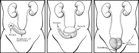 Types Of Urinary Diversion Procedures Ileal Conduit:, 56% OFF