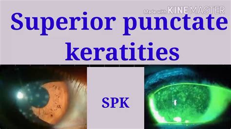 superficial punctate keratitis treatment | Superficial punctate keratitis grading | SPK | herpes ...