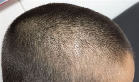 Boy Wrestles With Scalp Problem | Clinician Reviews