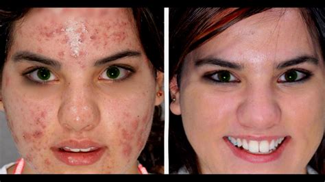 REMEDIO CONTRA EL ACNE: ZINC/cómo tomar zinc para curar el ACNE/ Zinc for Acne - YouTube