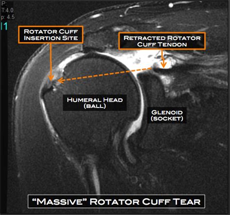 Rotator Cuff MRI Images