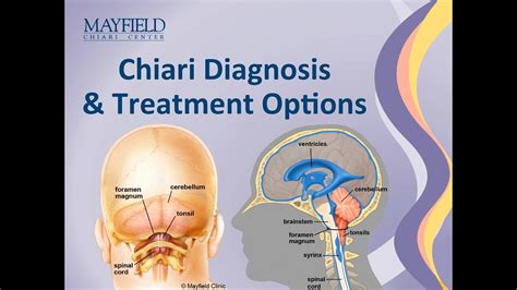 Chiari Malformation Diagnosis & Treatment Options - YouTube