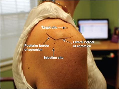 Deltoid Muscle Injection