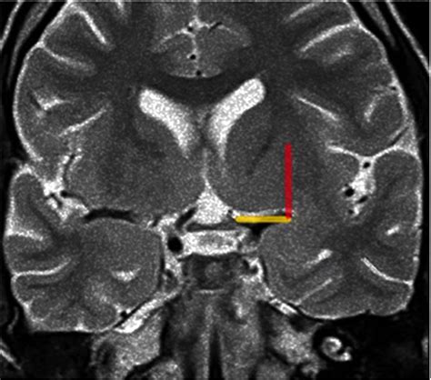 Coronal T2-weighted MRI at the level of the optic chiasm as an imaging ...