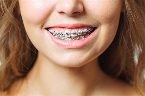 Ceramic Braces | Treatment, Cost & Professional Advice